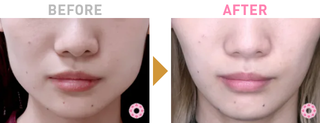 Before After 2