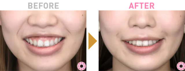 Before After 1