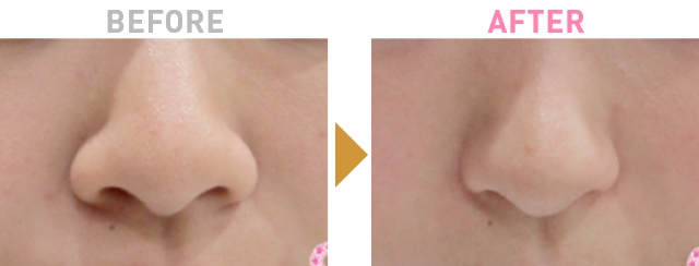 Before After 1