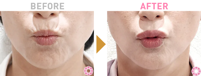 Before After 1