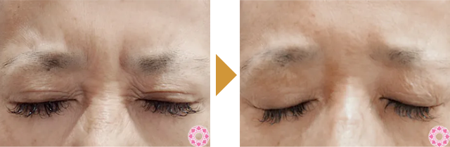 Before After 2