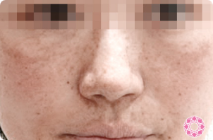 症例写真 ビフォー
