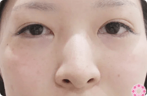 症例写真 アフター
