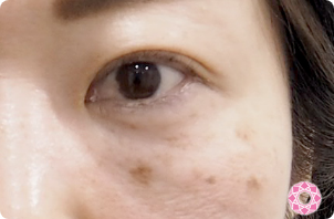 症例写真 ビフォー